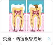 虫歯治療・根管治療