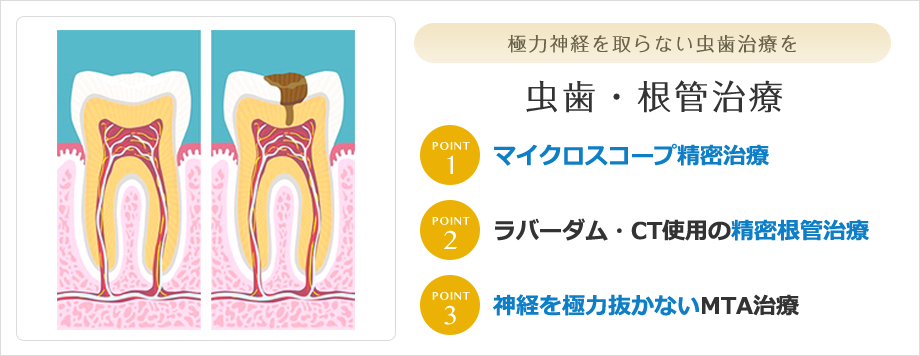 虫歯治療・根管治療