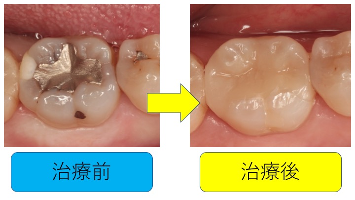 マイクロスコープ虫歯治療