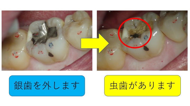 マイクロスコープ虫歯治療