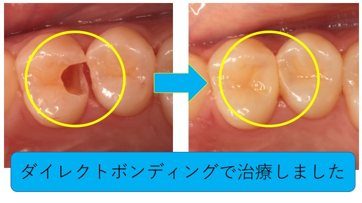 マイクロスコープ低侵襲治療