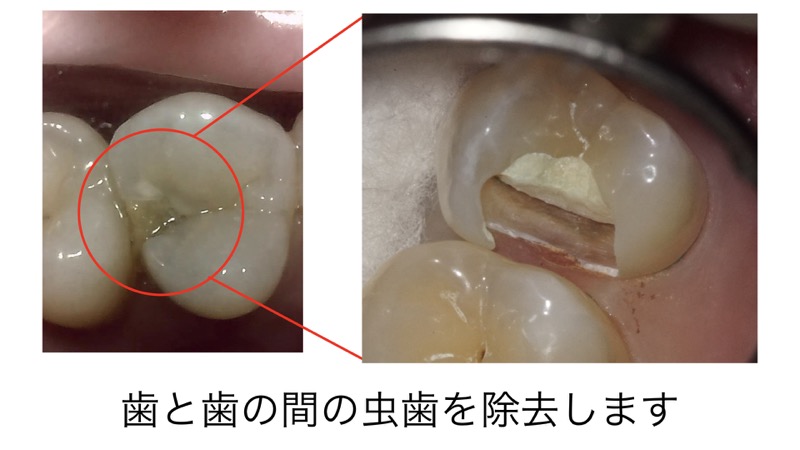 神経 を 抜い た 歯 寿命