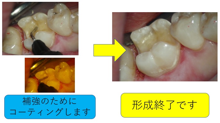 マイクロスコープ虫歯治療