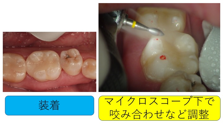 マイクロスコープ虫歯治療