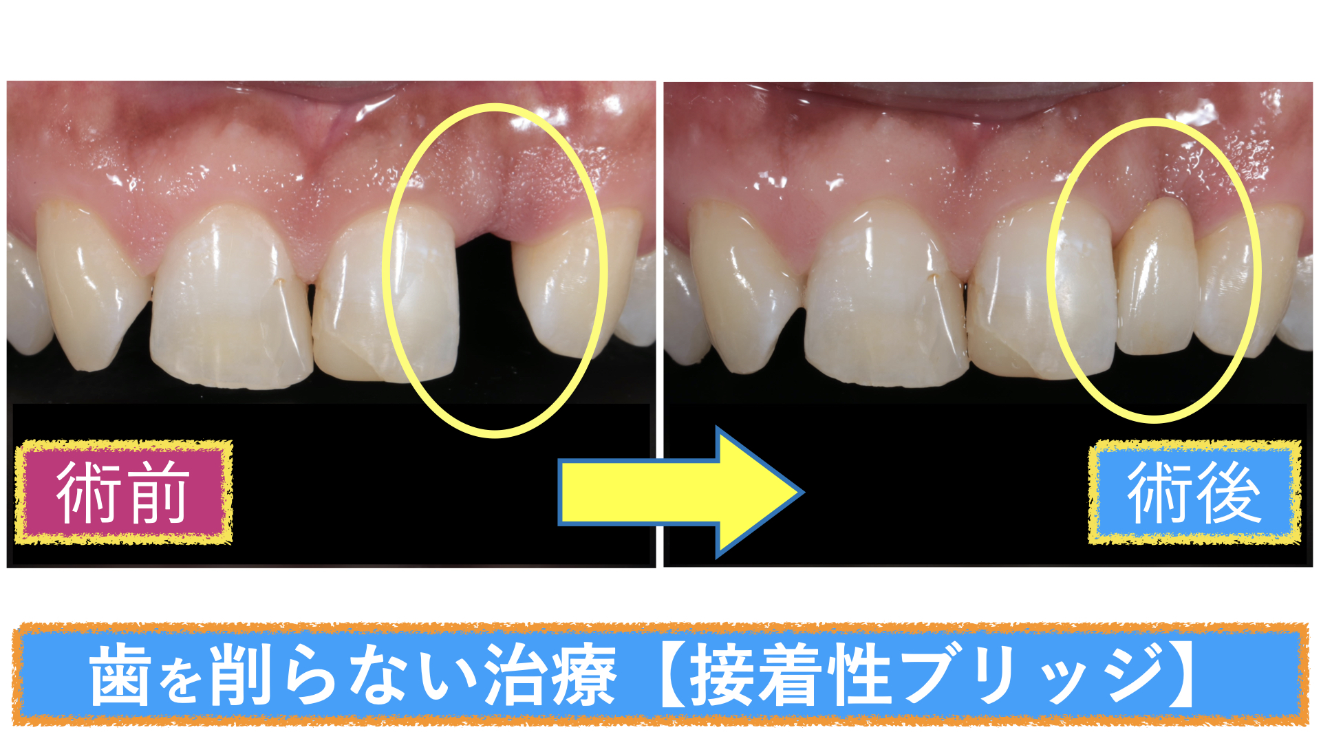 歯 を 削ら ない 歯医者