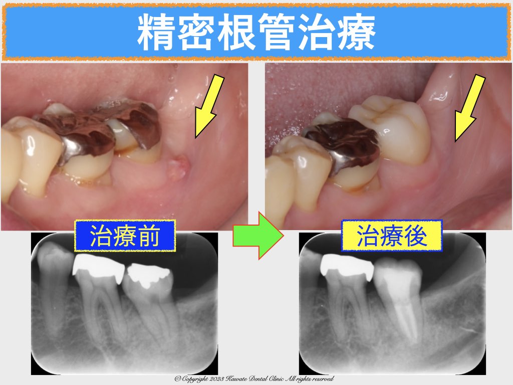 根 管 治療 歯茎 の 腫れ