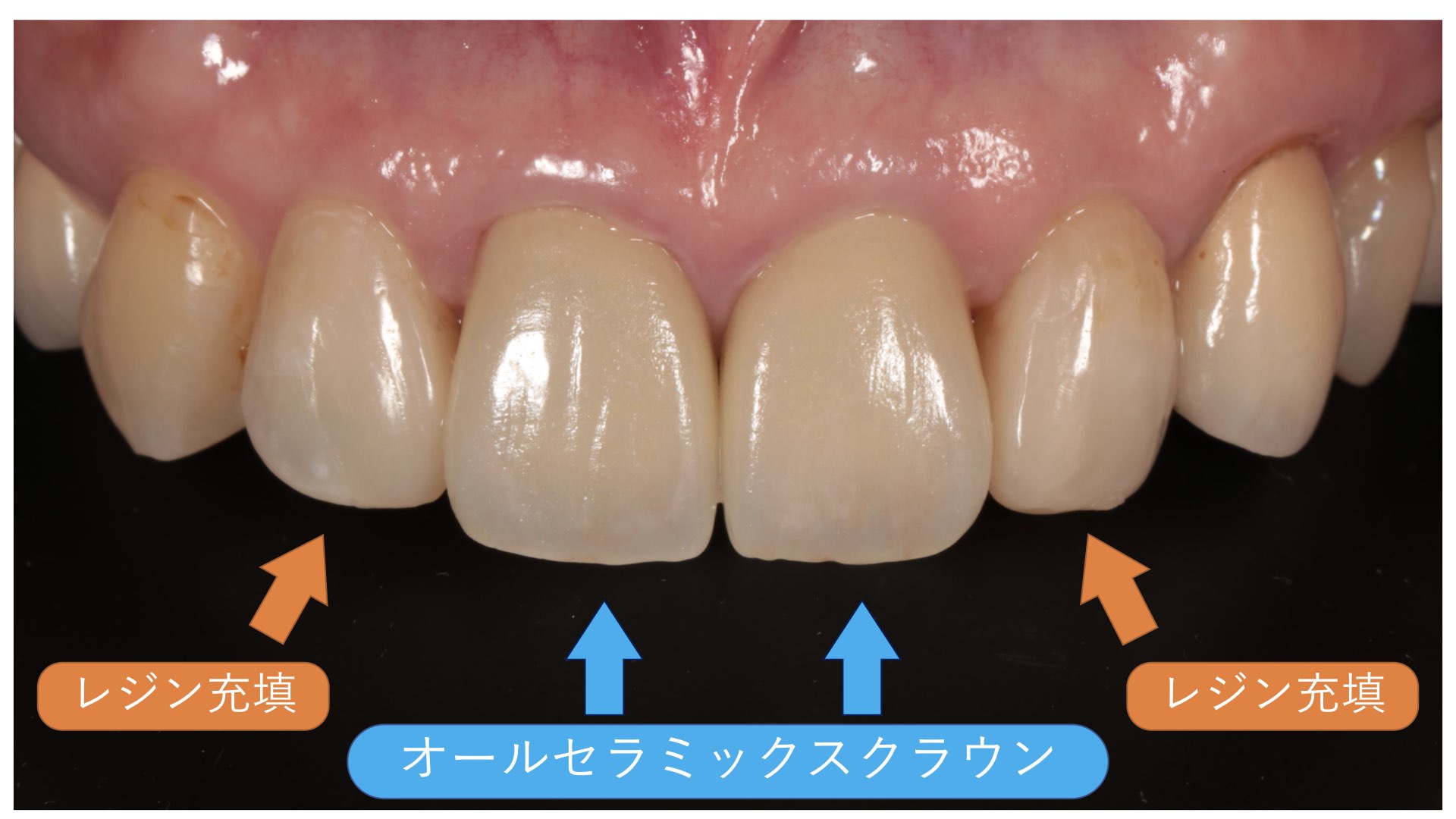 歯 を 治す と 運気 が 上がる