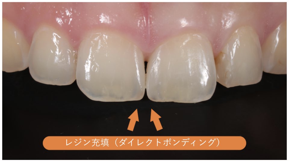 歯 と 歯 の 隙間 埋める