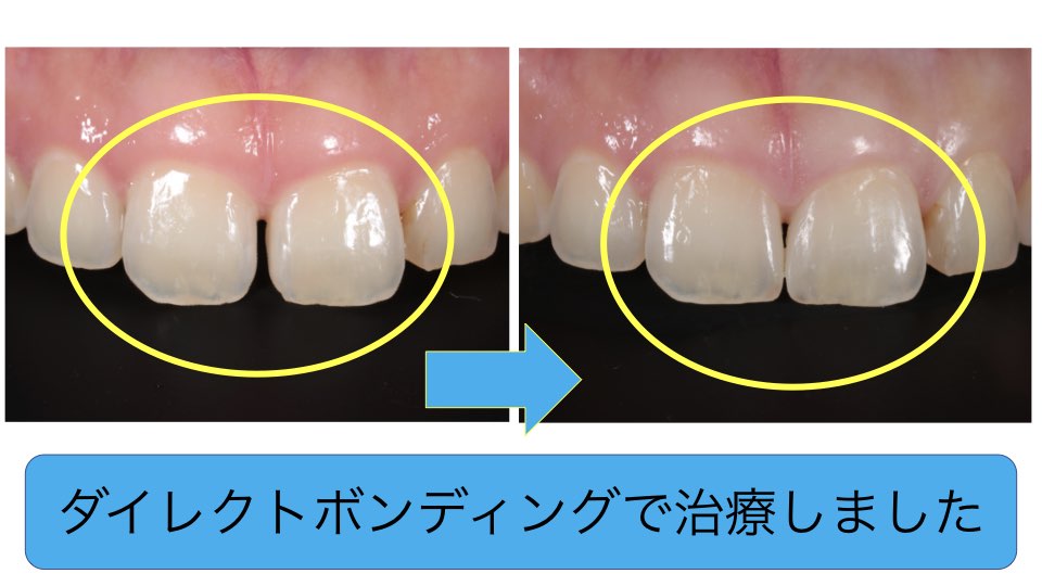 歯 と 歯 の 間 隙間 埋める