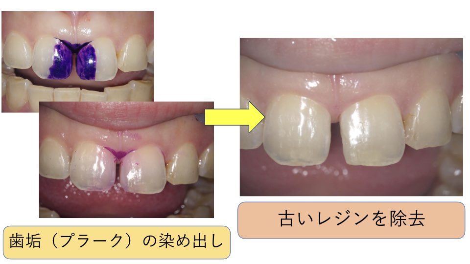 歯 の 隙間 を 埋める