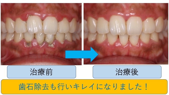 歯石 どれくらい で できる