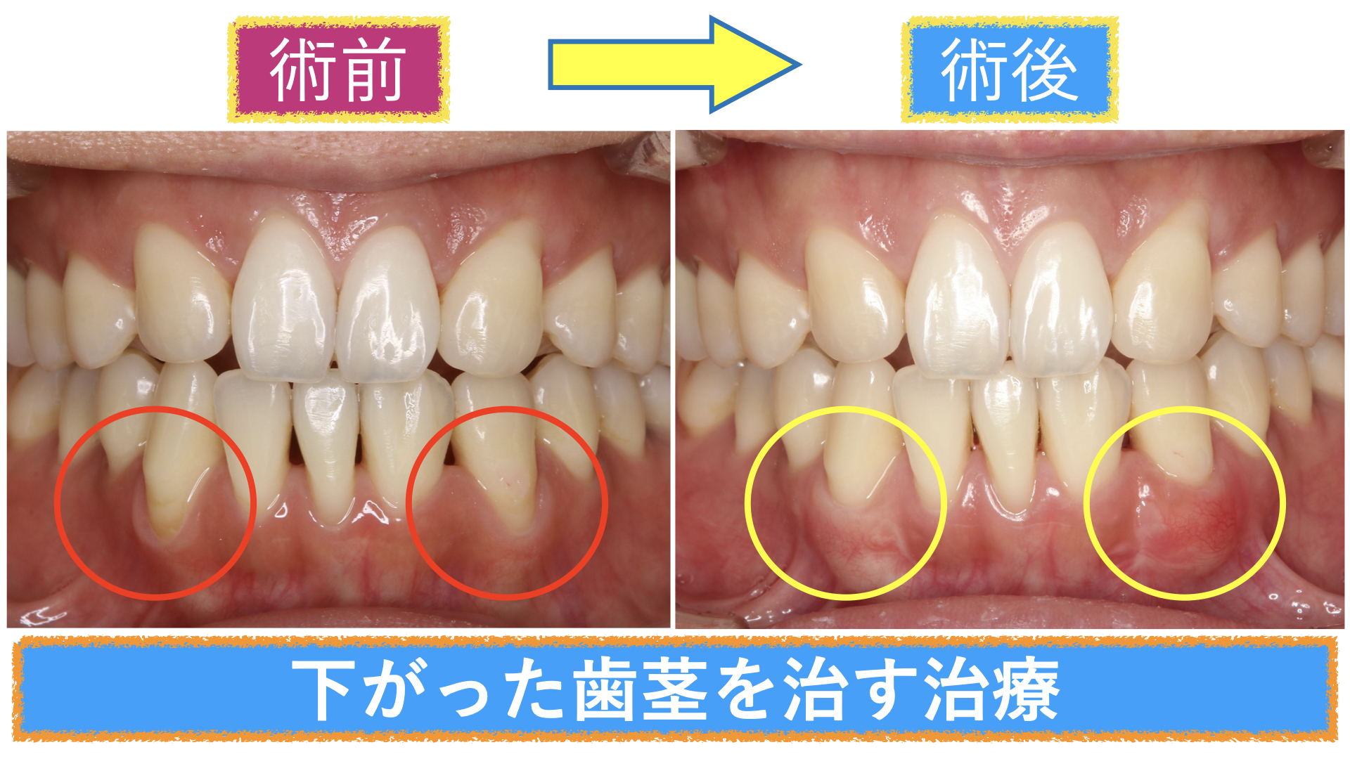 歯 に 歯茎 が かぶさる