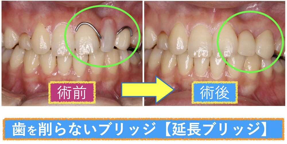 延長ブリッジによる前歯の審美治療症例