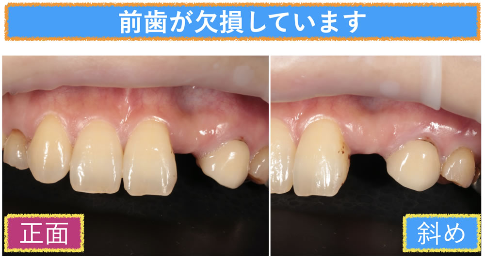 前歯の先天性欠如