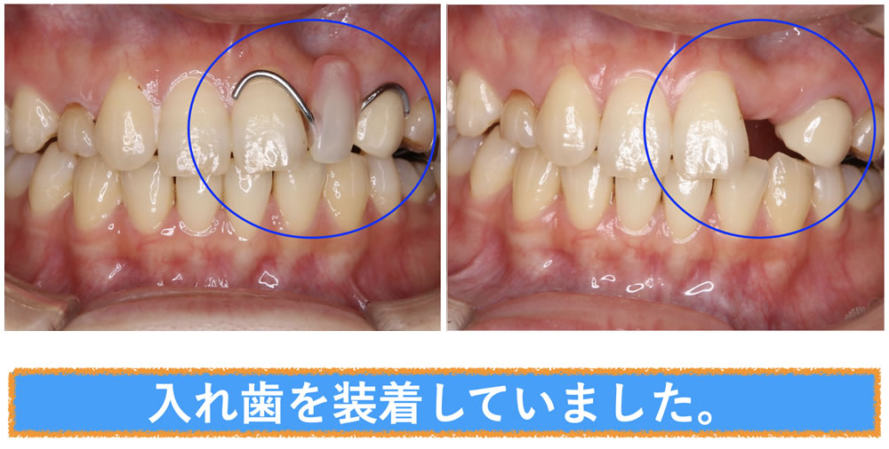 入れ歯装着時
