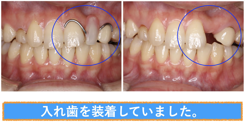 入れ歯装着時