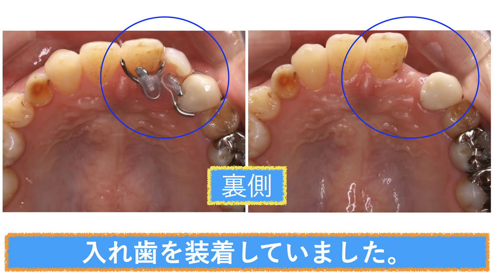 入れ歯装着時(裏側)