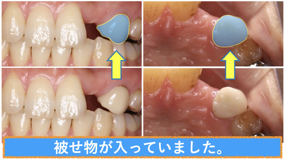 延長ブリッジでの審美修復治療