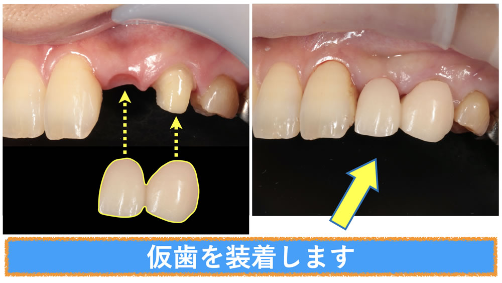 延長ブリッジでの審美修復治療