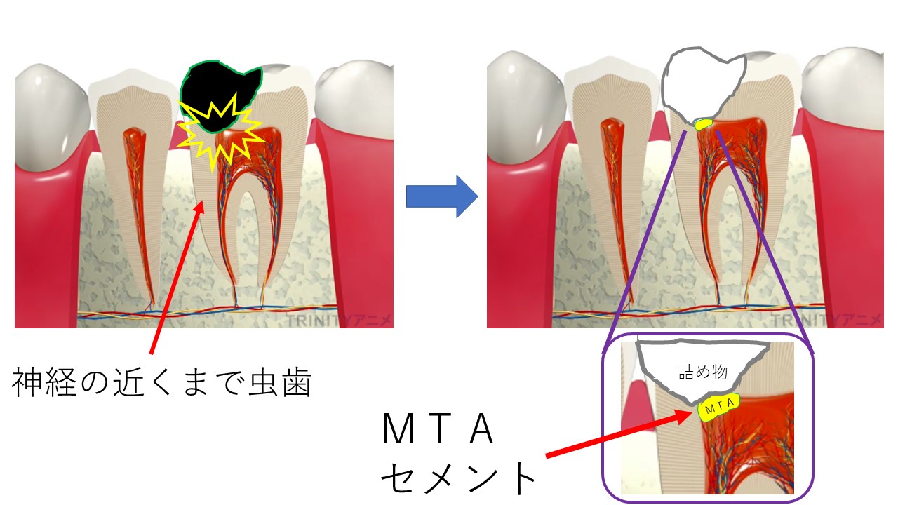 歯 の 神経 抜か ない 方 が いい