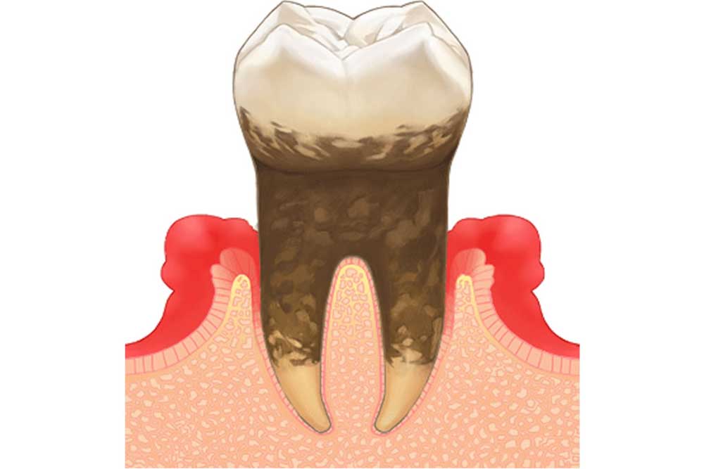 歯周病治療