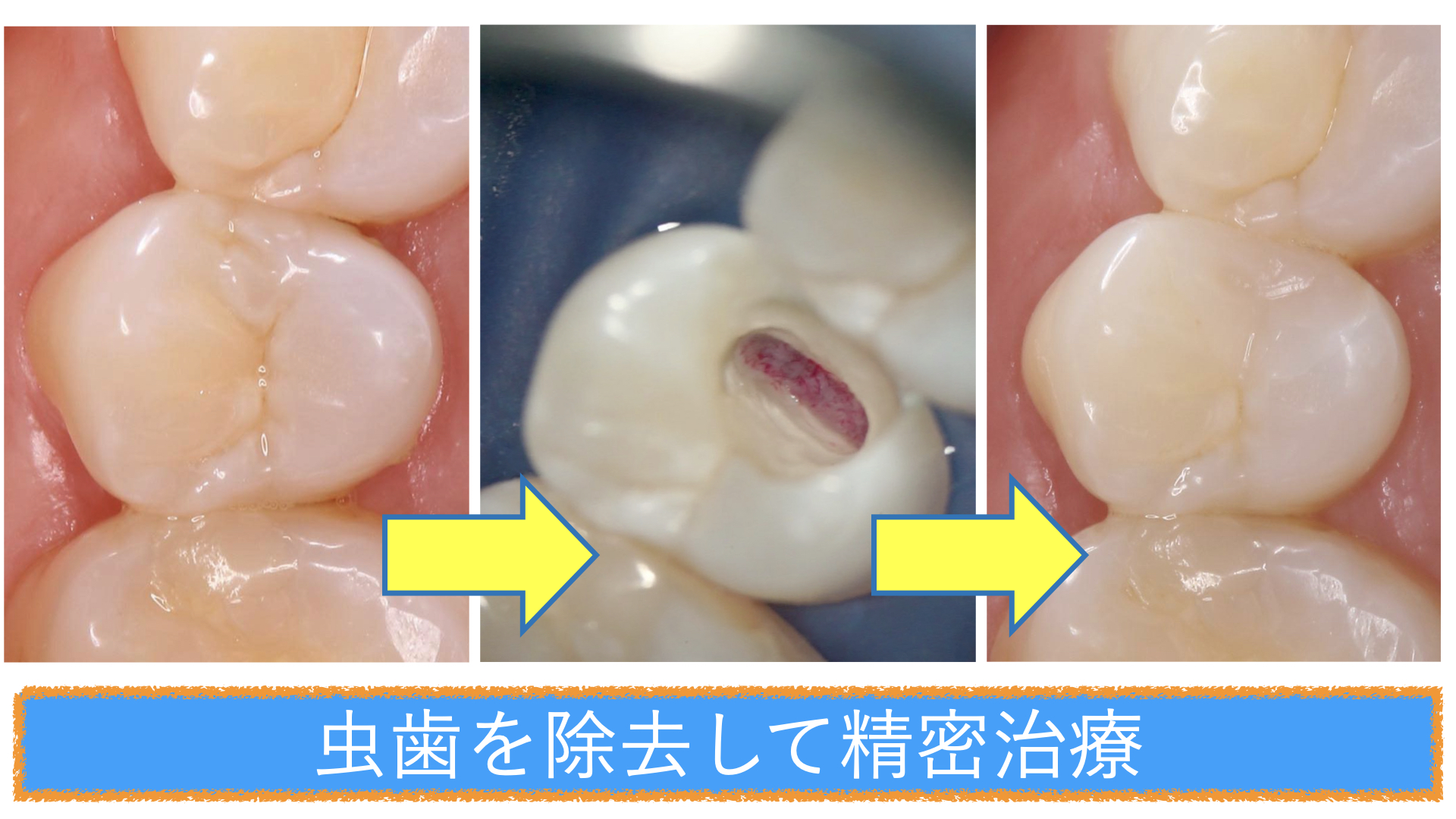 神経 抜く 歯