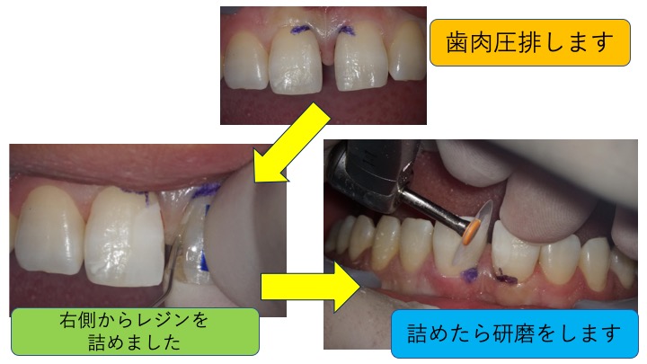 歯 と 歯 の 隙間 を 埋める