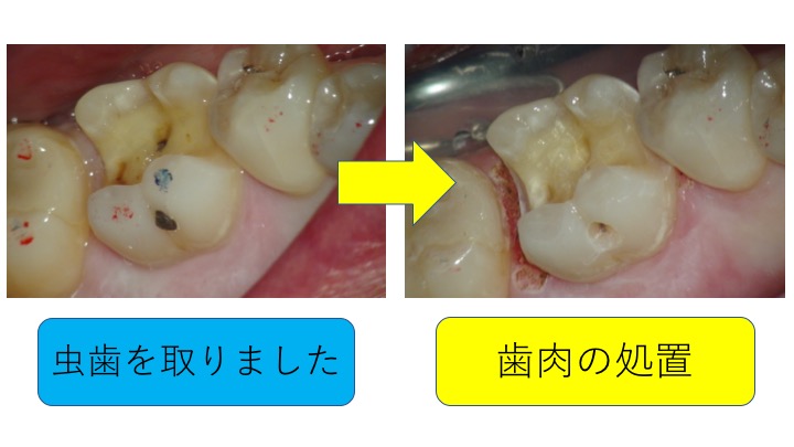 マイクロスコープ虫歯治療