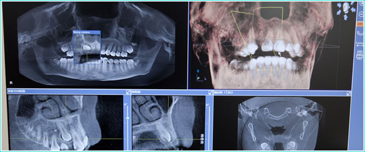 歯科用CT